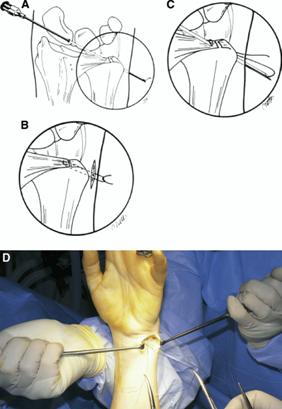 腕關節鏡手術修補三角纖維軟骨示意圖